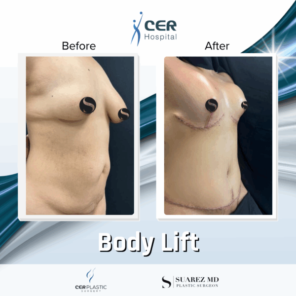 Body Lift - 213 - Image 4