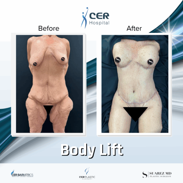 Body Lift - 291 - Image 5