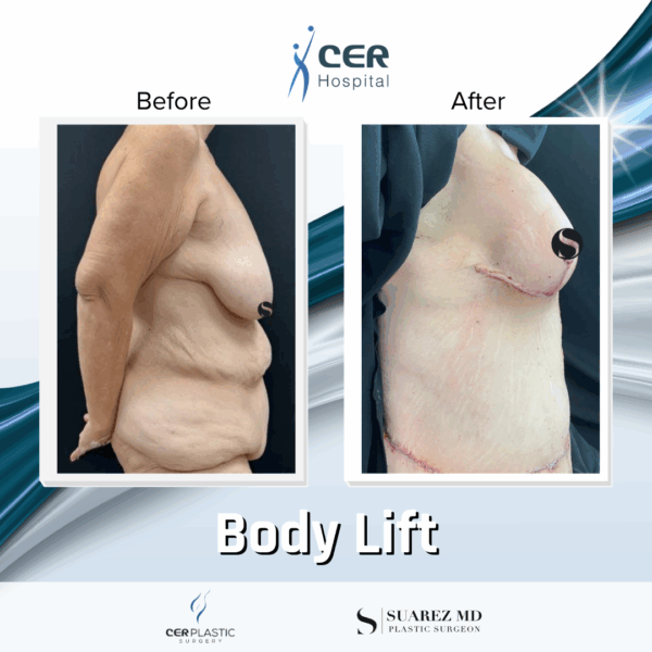 Body Lift - 075 - Image 5