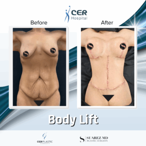 Body Lift – 304