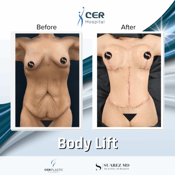 Body Lift - 304