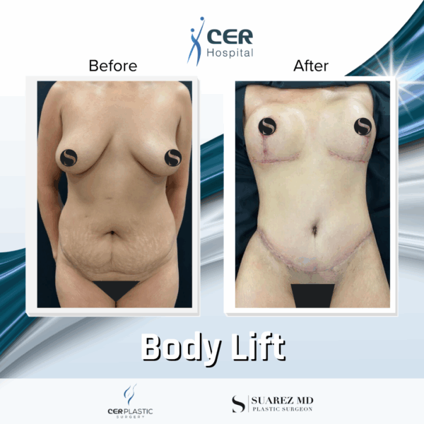 Body Lift - 234 - Image 5