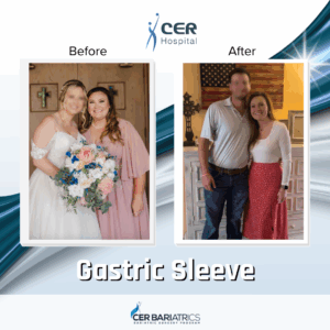 Gastric Sleeve