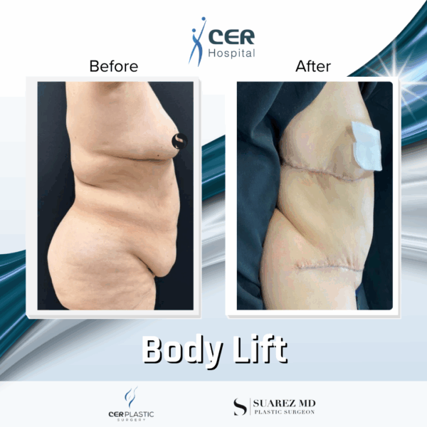Body Lift - 144 - Image 5