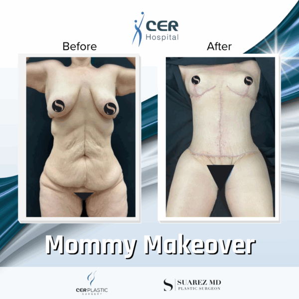 Mommy Makeover - 311 - Image 4