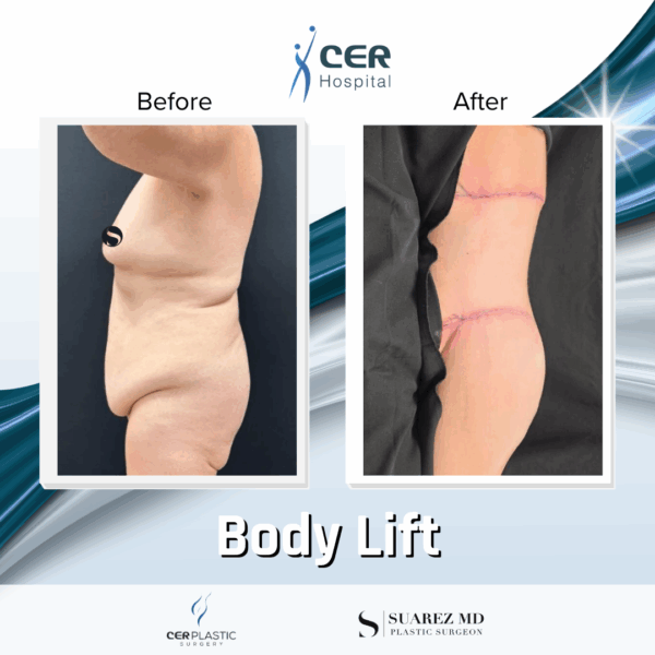 Body Lift - 037 - Image 3