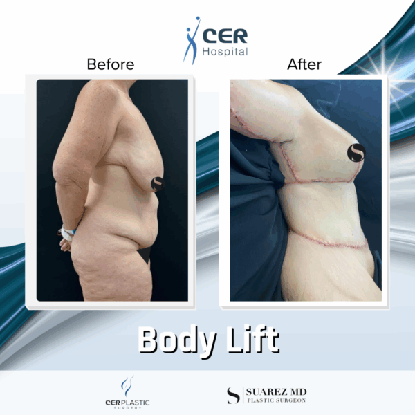 Body Lift -2094 - Image 5