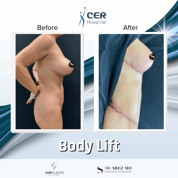 Body Lift -7104 - Image 6