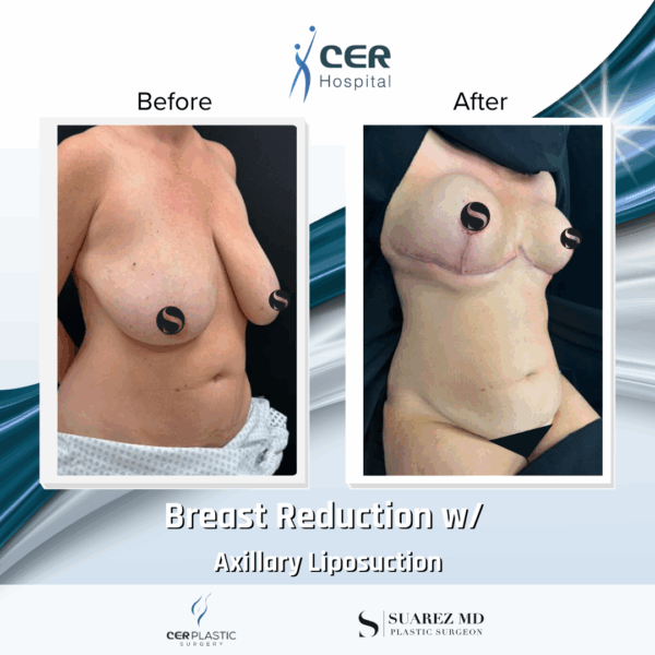 Breast Reduction and Axillary Liposuction - 042 - Image 5