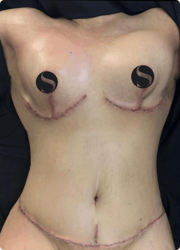 Body Lift - 213 - Image 2