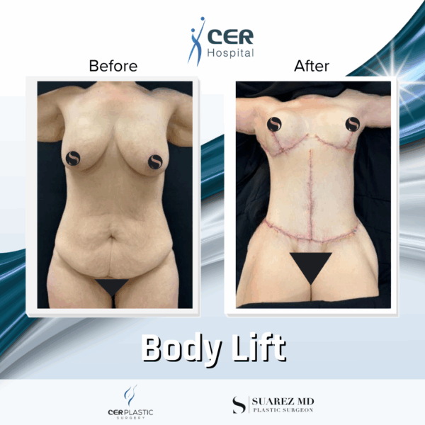 Body Lift - 26064 - Image 5