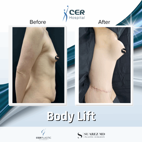 Body Lift - 19064 - Image 5