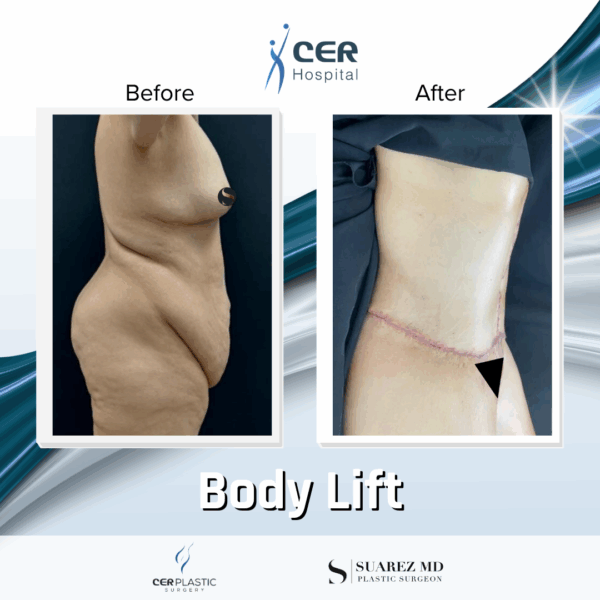 Body Lift - 17064