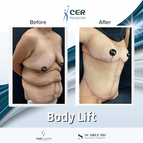 Body Lift -14064 - Image 5