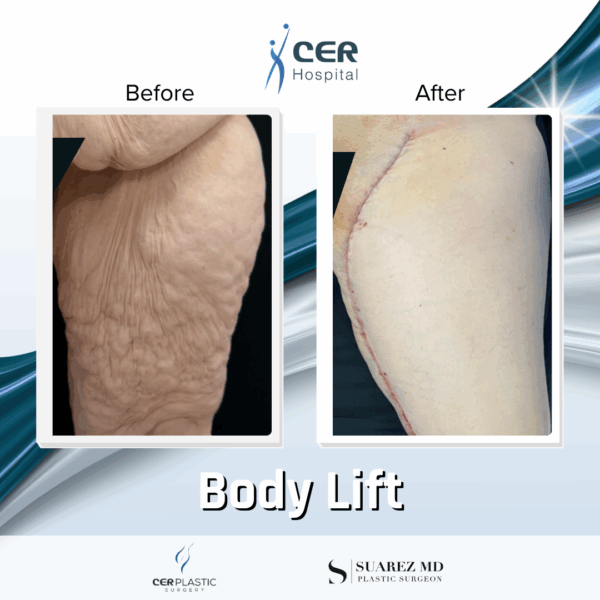 Mini Body Lift - 12064 - Image 5