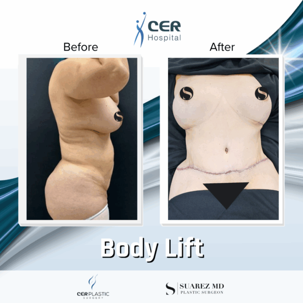 Body Lift and Eyelid Surgery - 5064 - Image 4
