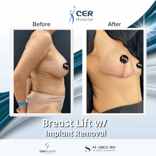 Breast Lift with Implant Removal - 5064 - Image 5