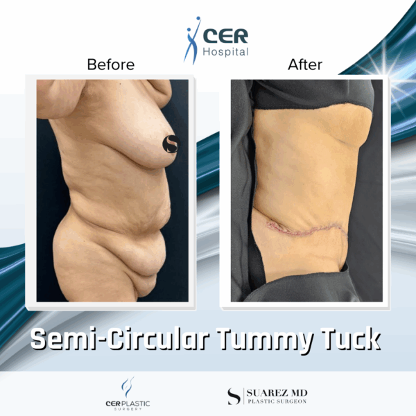 Semi Circular Tummy Tuck - 3064 - Image 5