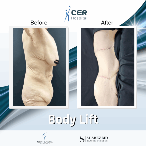 Body Lift - 17054 - Image 4