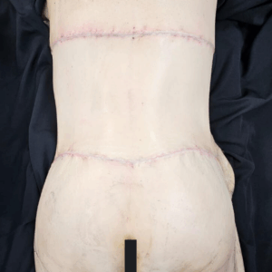 Body Lift – 17054
