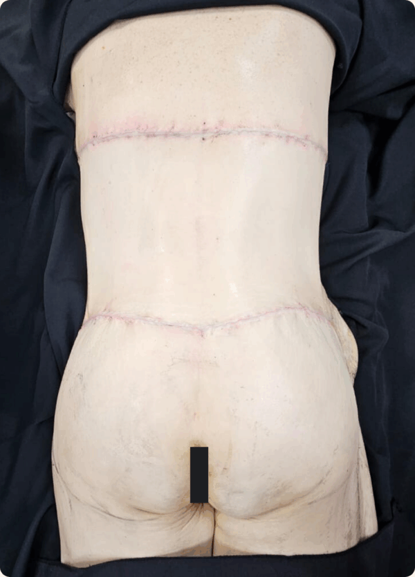 Body Lift - 17054 - Image 2
