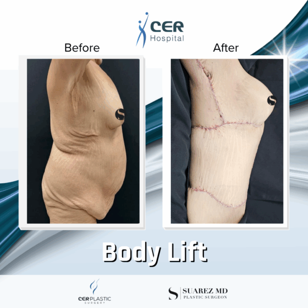 Body Lift - 8054 - Image 5