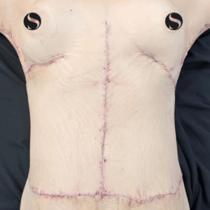 Body Lift – 8054