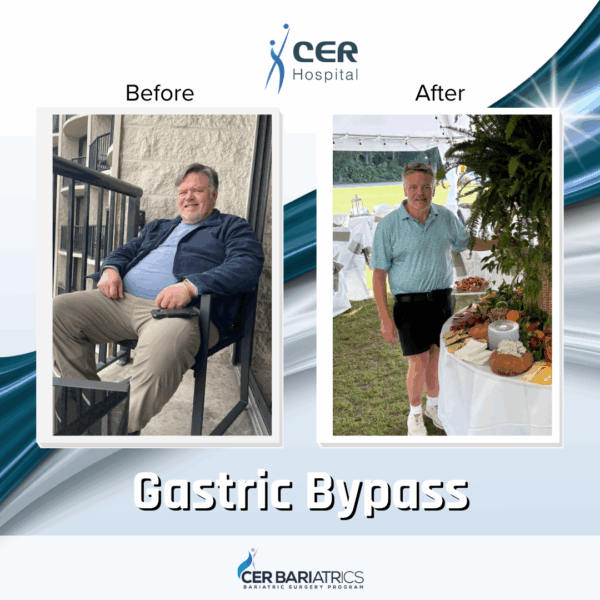 Gastric Bypass - Image 2