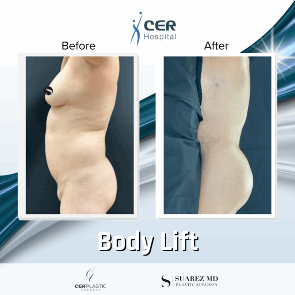 Body Lift - 284 - Image 5