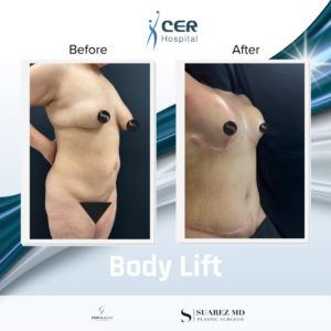Body Lift – 210325