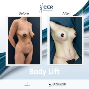 Body Lift – 120525