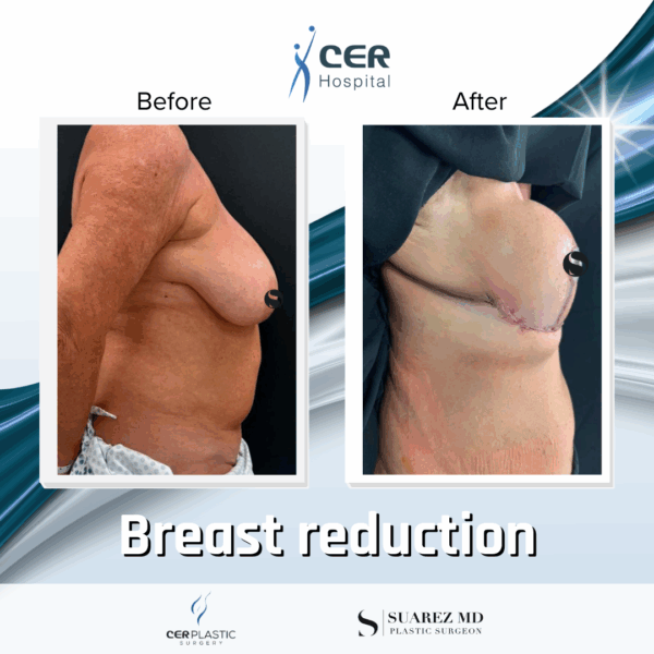 Breast Reduction - 042 - Image 5