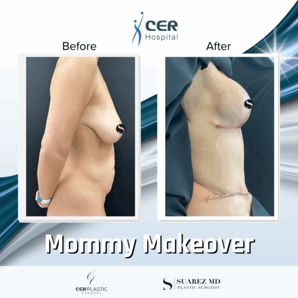 Mommy Makeover - 063 - Image 4