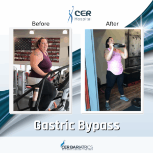 Gastric Bypass