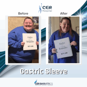 Gastric Sleeve