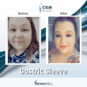 Gastric Sleeve