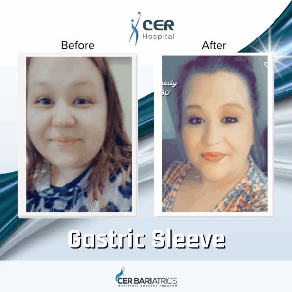 Gastric Sleeve