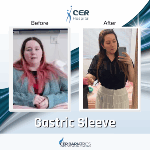 Gastric Sleeve