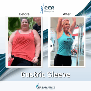 Gastric Sleeve