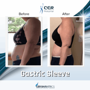 Gastric Sleeve