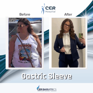 Gastric Sleeve