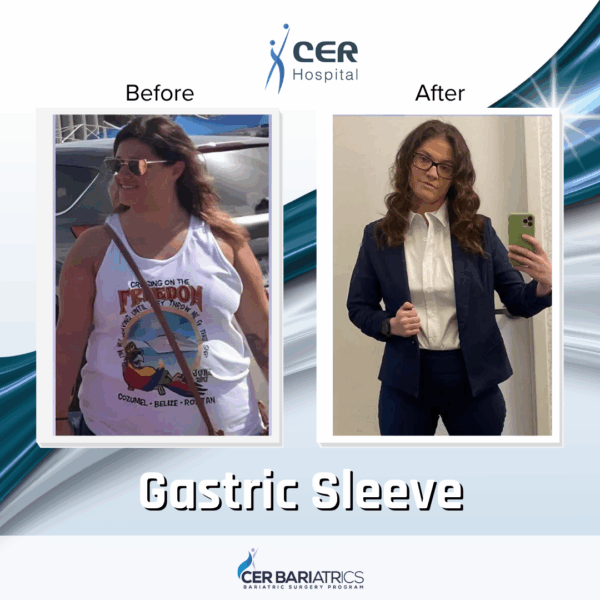 Gastric Sleeve
