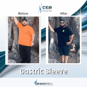 Gastric Sleeve