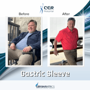 Gastric Sleeve