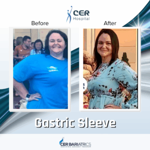 Gastric Sleeve