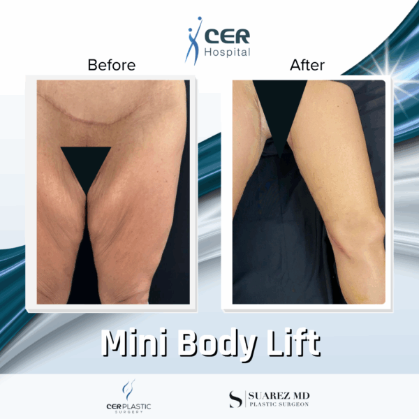 Mini Body Lift - 073 - Image 6
