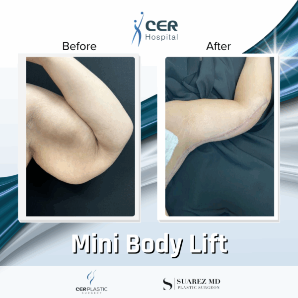 Mini Body Lift - 193 - Image 5