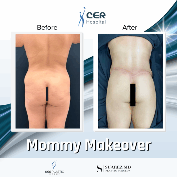 Mommy Makeover - 061 - Image 5