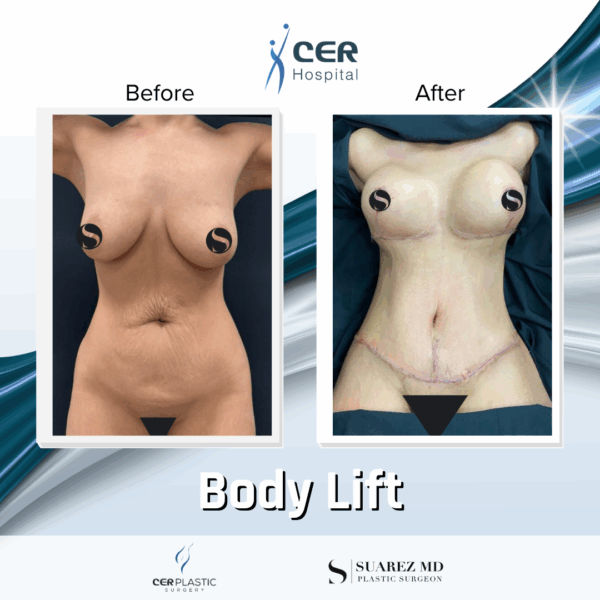 Body Lift - 125 - Image 6