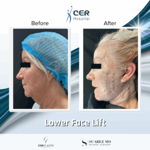 Lower Face Lift – 033